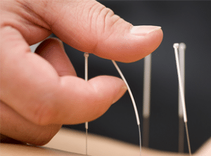 Acupuncture – restoring the balance
